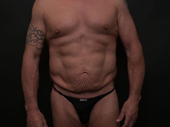 Male Procedures Case 1 - Before