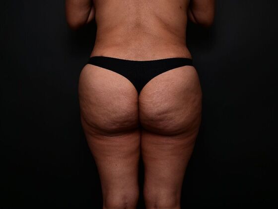 Mommy Makeover: Case 5 - After