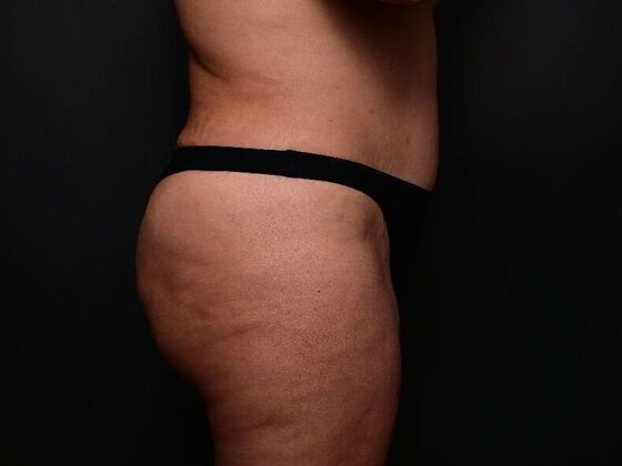 Mommy Makeover: Case 5 - After