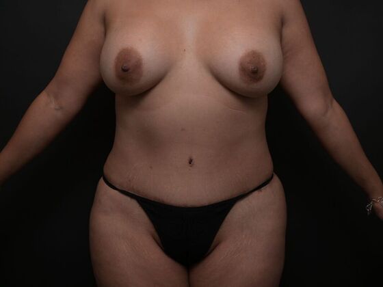 Mommy Makeover Case 5 - Before