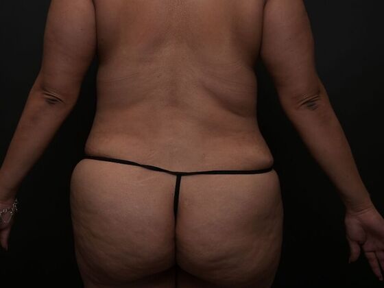 Mommy Makeover: Case 5 - Before