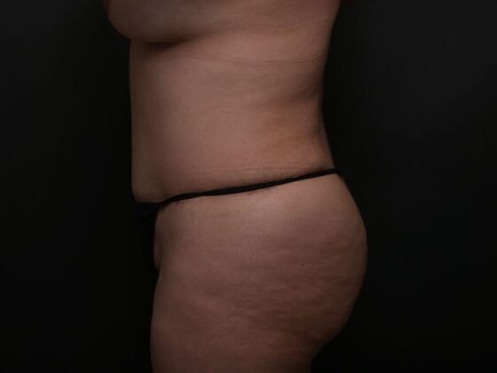 Mommy Makeover: Case 5 - Before