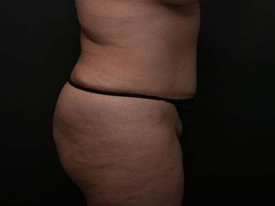 Mommy Makeover: Case 5 - Before