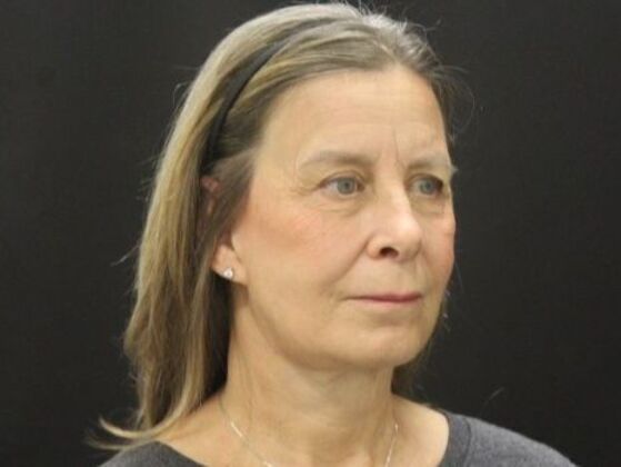 Face & Neck Lifts: Case 53 - After