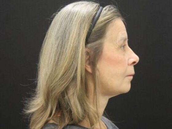 Face & Neck Lifts: Case 53 - After