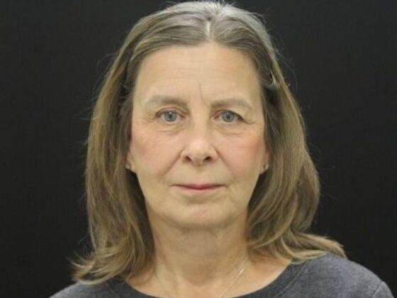 Face & Neck Lifts Case 53 - After