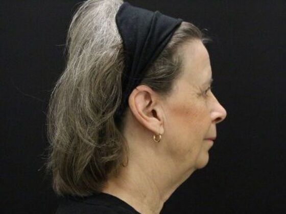 Face & Neck Lifts: Case 53 - Before