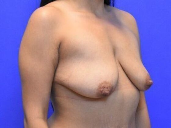 Breast Lift: Case 11 - Before