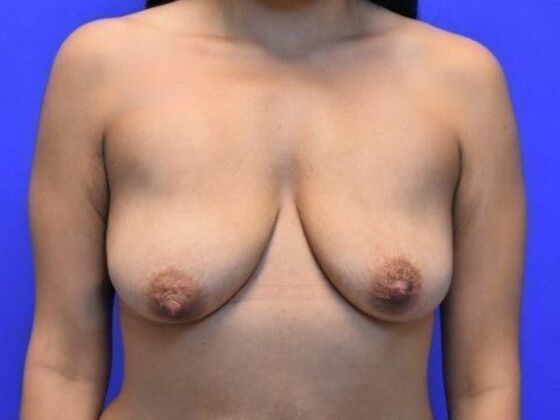 Breast Lift Case 11 - Before