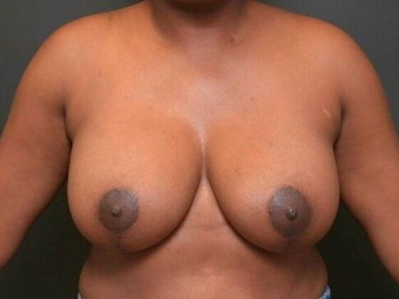 Breast Lift Case 13 - Before