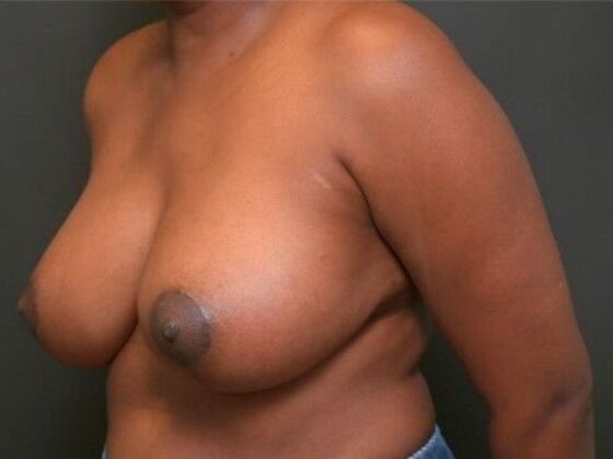 Breast Lift: Case 13 - Before
