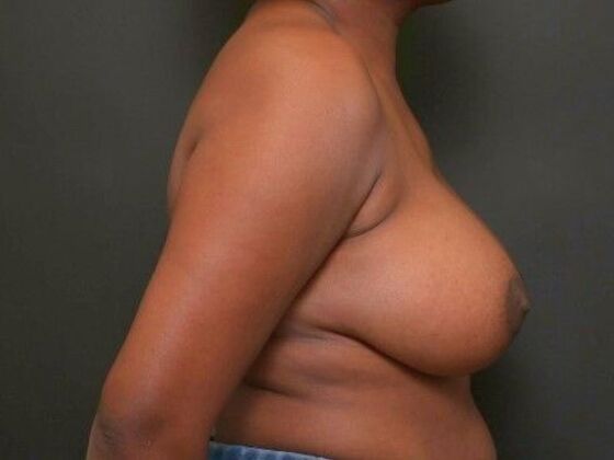 Breast Lift: Case 13 - Before