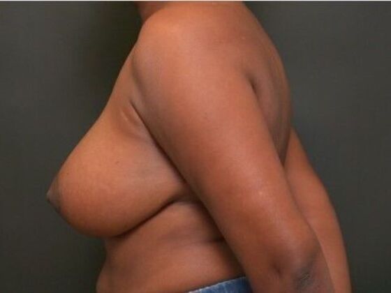 Breast Lift: Case 13 - Before