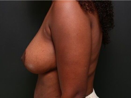 Breast Lift: Case 13 - After
