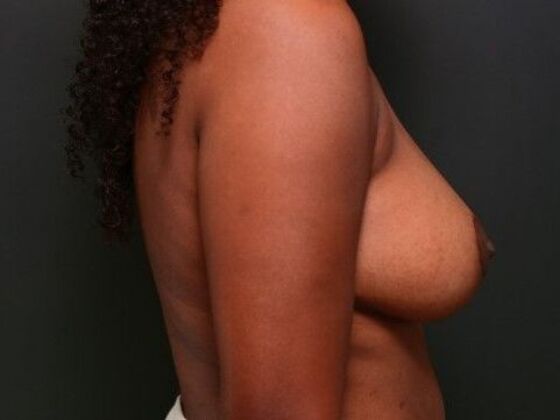 Breast Lift: Case 13 - After