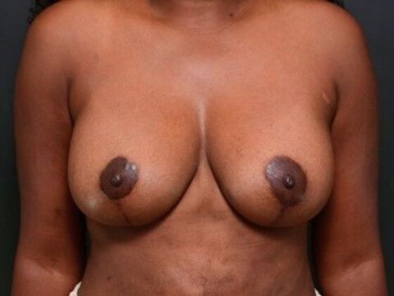 Breast Lift Case 13 - After
