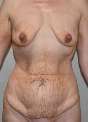 Mommy Makeover Case 356 - Before