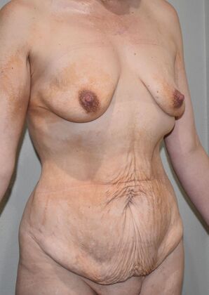 Massive Weight Loss : Case 191 - Before