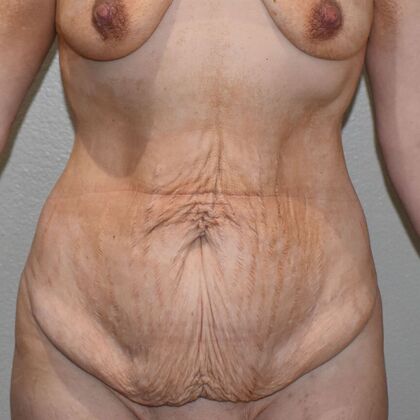 Tummy Tuck (Abdominoplasty) Case 14 - Before