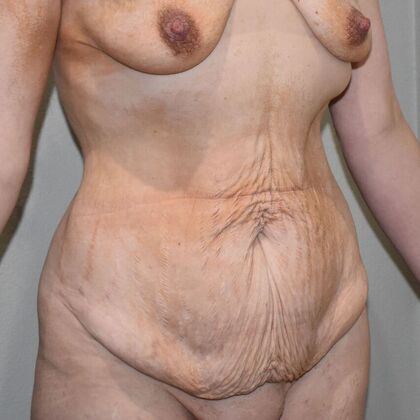 Tummy Tuck (Abdominoplasty): Case 14 - Before
