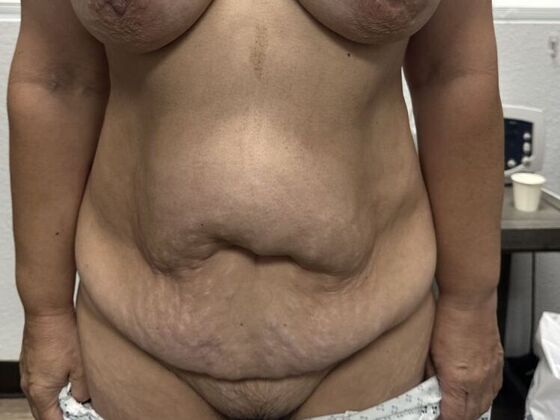 Tummy Tuck (Abdominoplasty) Case 31 - Before