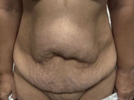 Tummy Tuck (Abdominoplasty) Case 31 - Before