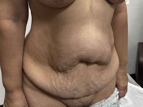 Tummy Tuck (Abdominoplasty): Case 31 - Before