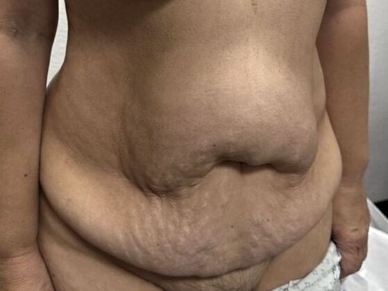 Tummy Tuck (Abdominoplasty): Case 31 - Before
