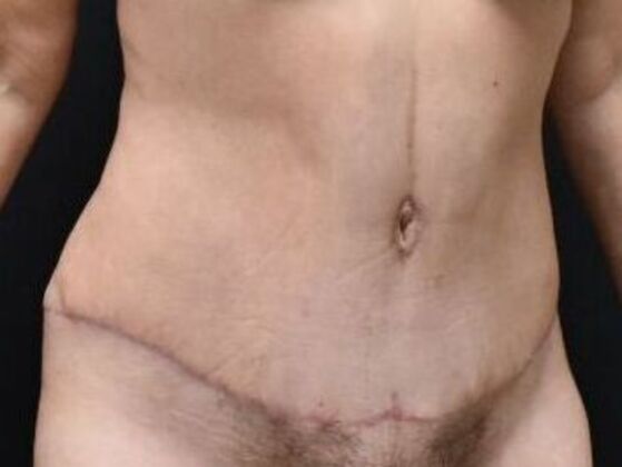 Tummy Tuck (Abdominoplasty): Case 31 - After