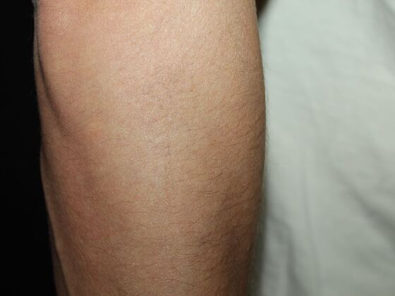 Laser Tattoo Removal Case 45 - After