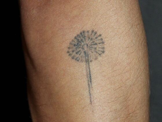 Laser Tattoo Removal Case 45 - Before