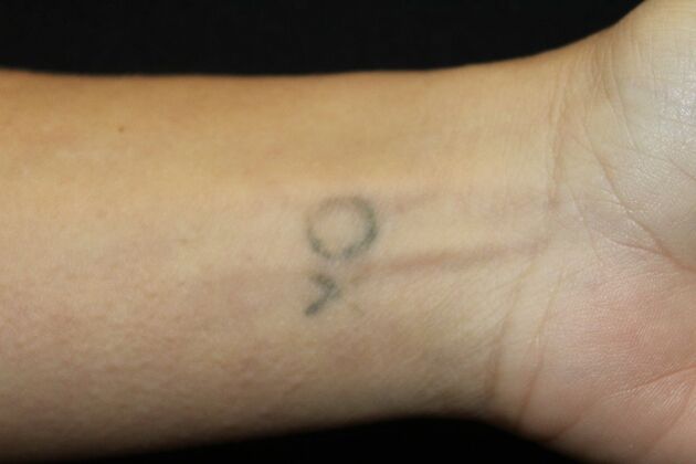 Laser Tattoo Removal Case 46 - Before