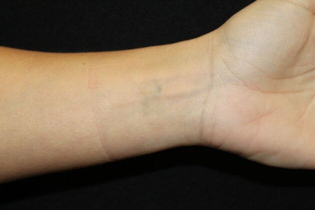 Laser Tattoo Removal Case 46 - After