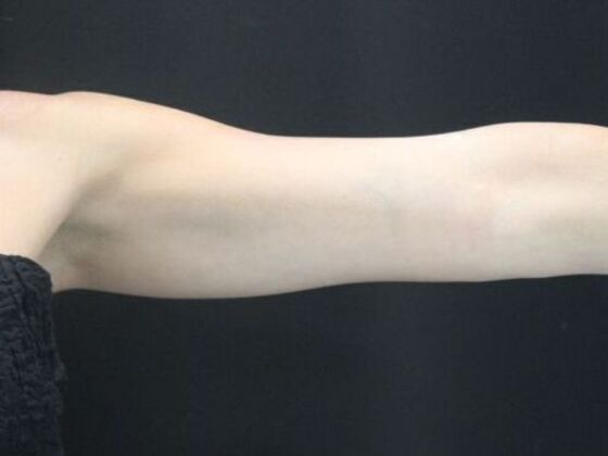 CoolSculpting Case 14 - Before