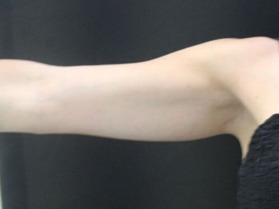 CoolSculpting: Case 14 - Before