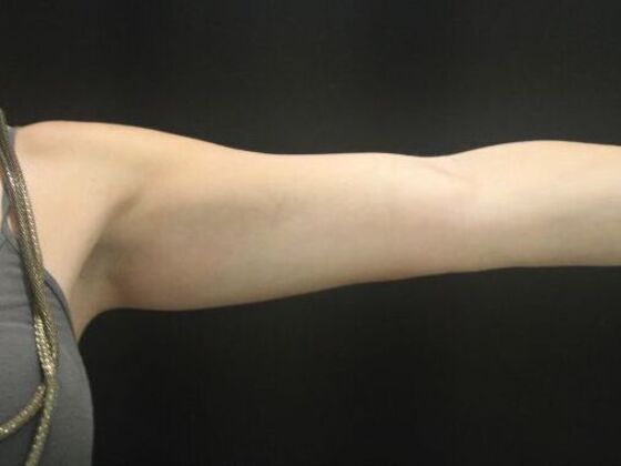 CoolSculpting Case 14 - After