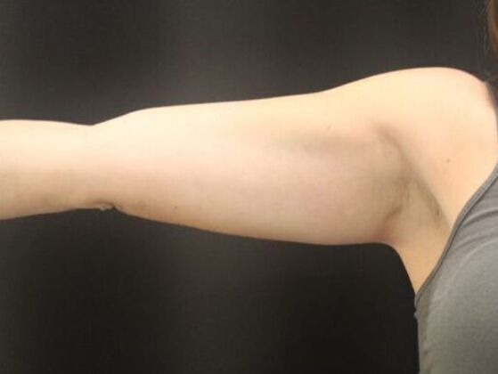 CoolSculpting: Case 14 - After