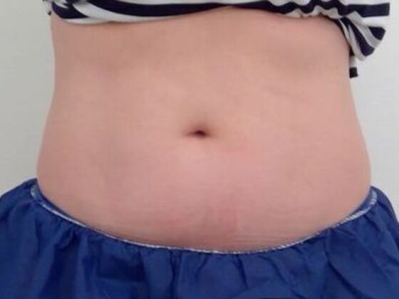 CoolSculpting Case 15 - Before