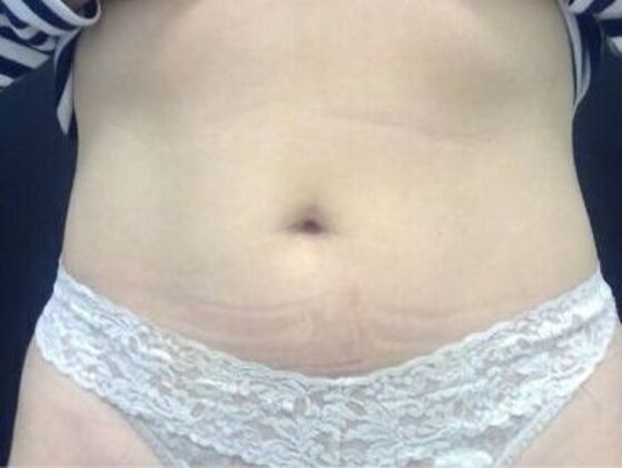 CoolSculpting Case 15 - After