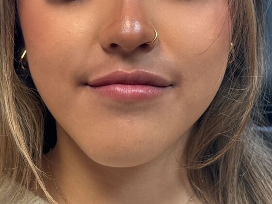 Cosmetic Injectables & Fillers*: Case 67 - After