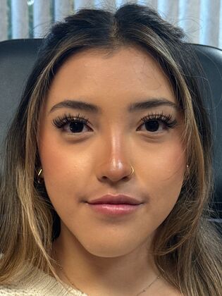 Cosmetic Injectables & Fillers*: Case 67 - After