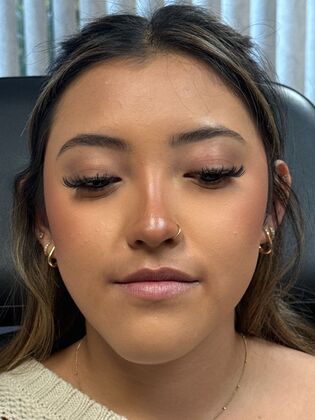 Cosmetic Injectables & Fillers*: Case 67 - Before