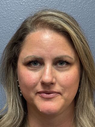 Cosmetic Injectables & Fillers*: Case 68 - Before