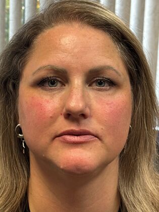 Cosmetic Injectables & Fillers*: Case 68 - After