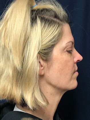 Cosmetic Injectables & Fillers*: Case 69 - After