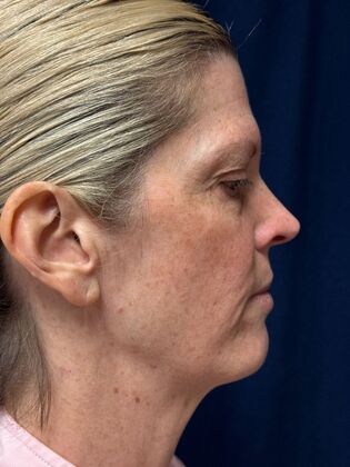 Cosmetic Injectables & Fillers*: Case 69 - Before