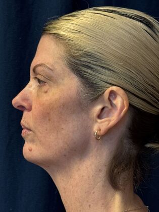 Cosmetic Injectables & Fillers*: Case 69 - Before