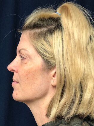 Cosmetic Injectables & Fillers*: Case 69 - After