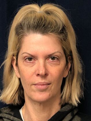 Cosmetic Injectables & Fillers*: Case 69 - After