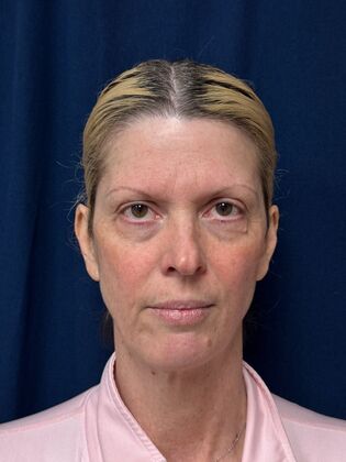 Cosmetic Injectables & Fillers*: Case 69 - Before